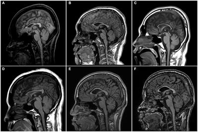 Clinical analysis in patients with SPG11 hereditary spastic paraplegia